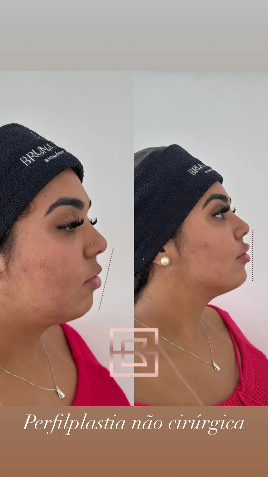 Perfilplastias - Antes e Depois