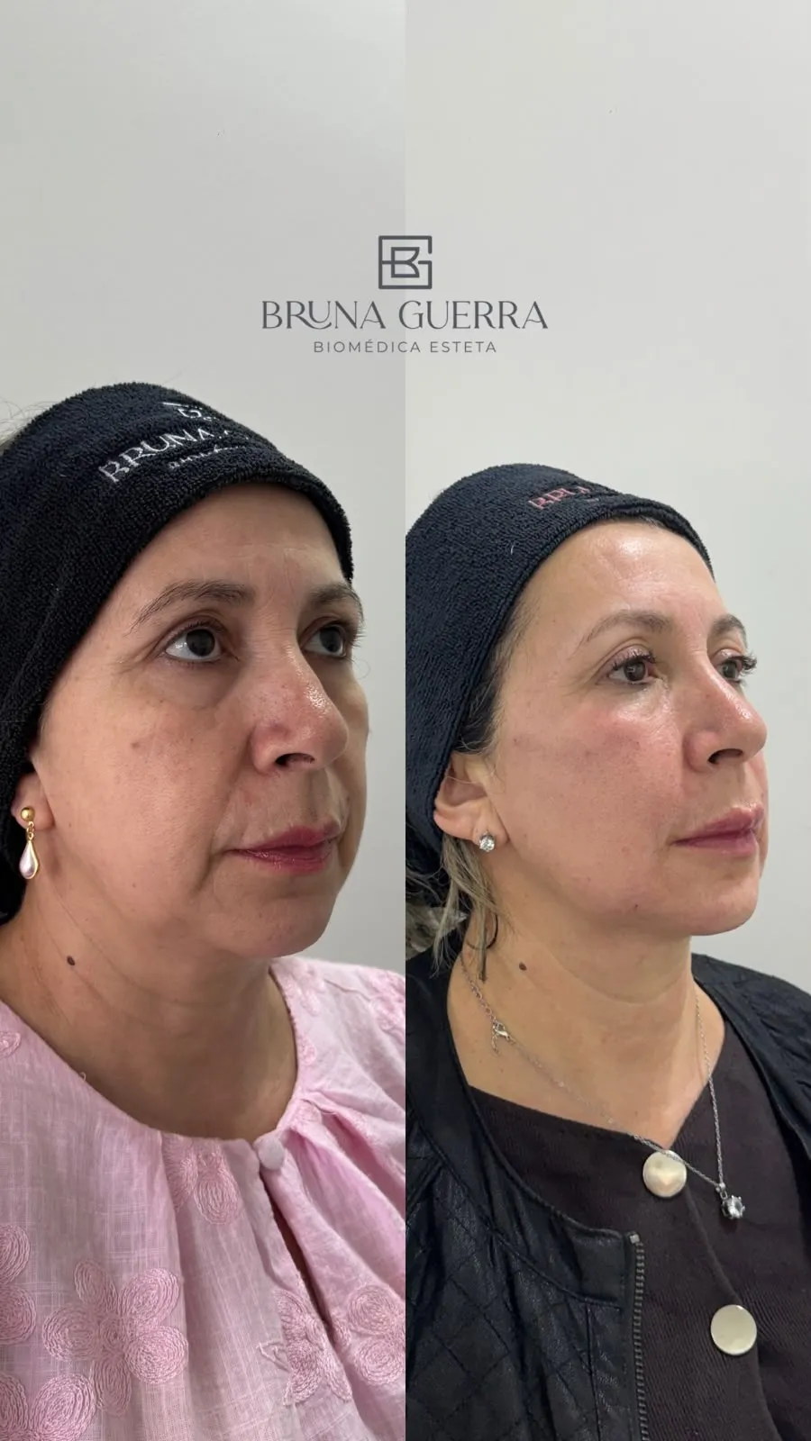 Preenchimento Labial - Antes e Depois