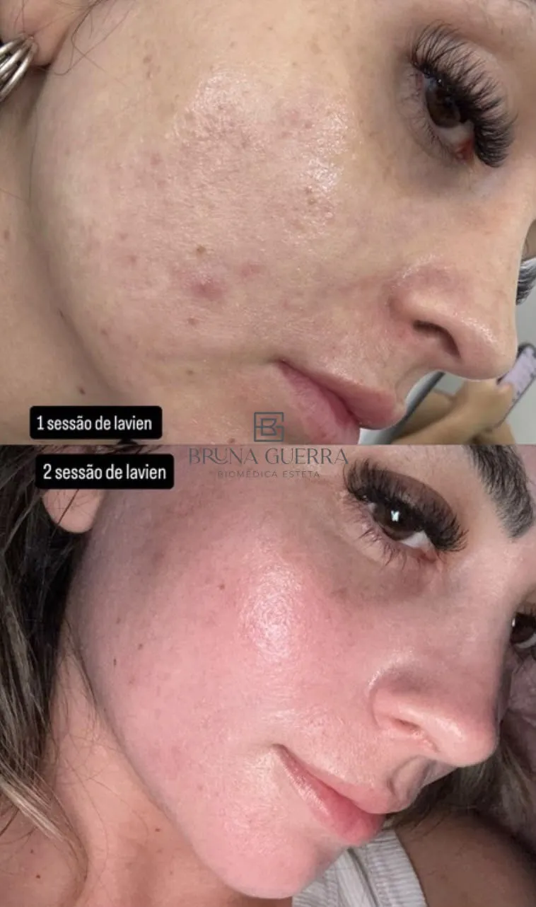 Contorno Labial - Antes e Depois