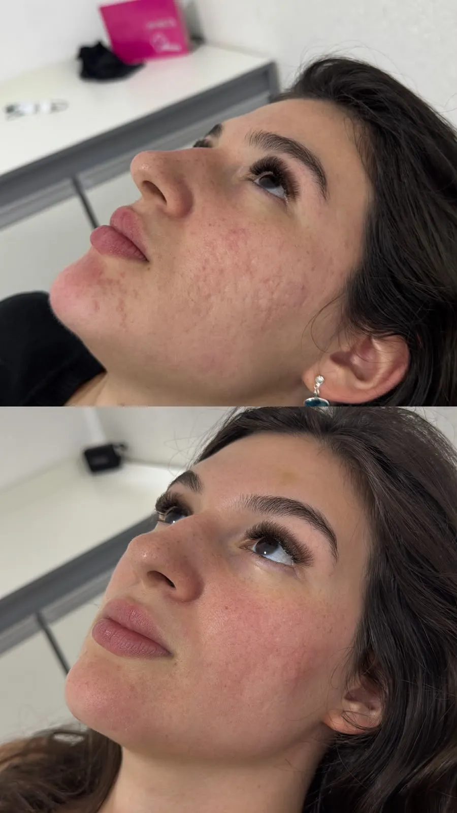 Lifting Facial - Antes e Depois