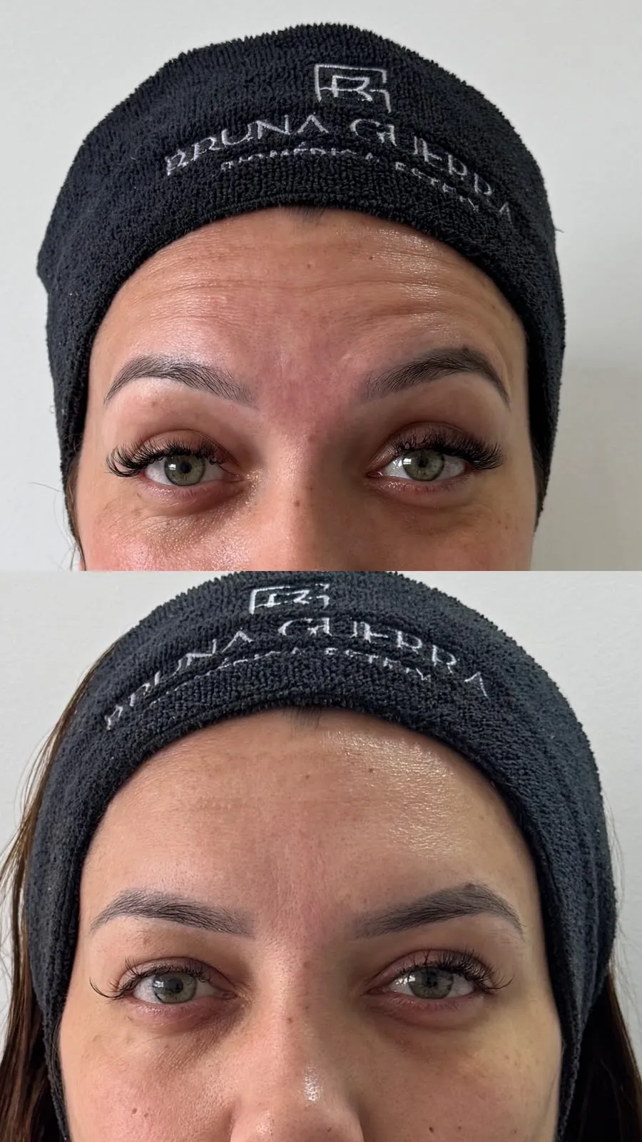 Volume de Malar - Antes e Depois