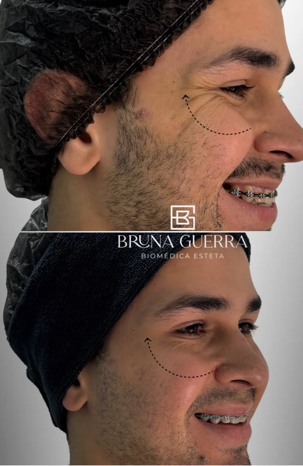 Projeção Mental - Antes e Depois