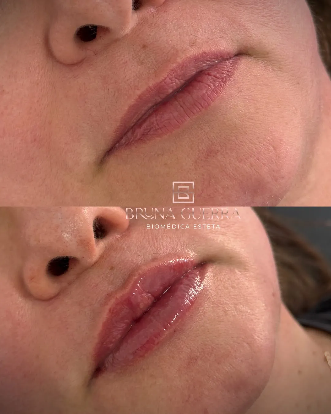 Definição de Mandíbula - Antes e Depois